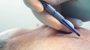 Greffe cheveux Casablanca | Clinique transplantation capillaire Maroc